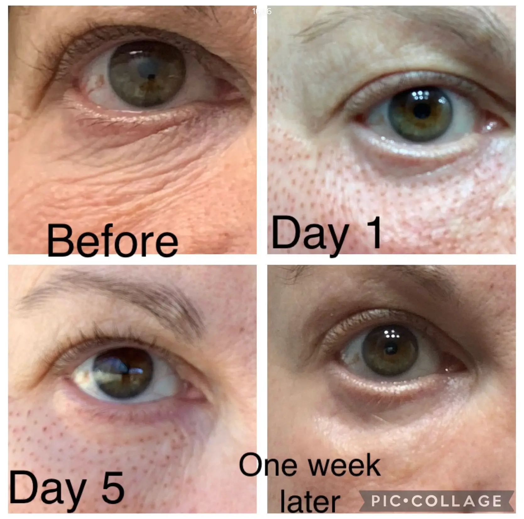 Eye-area skin tightening progress