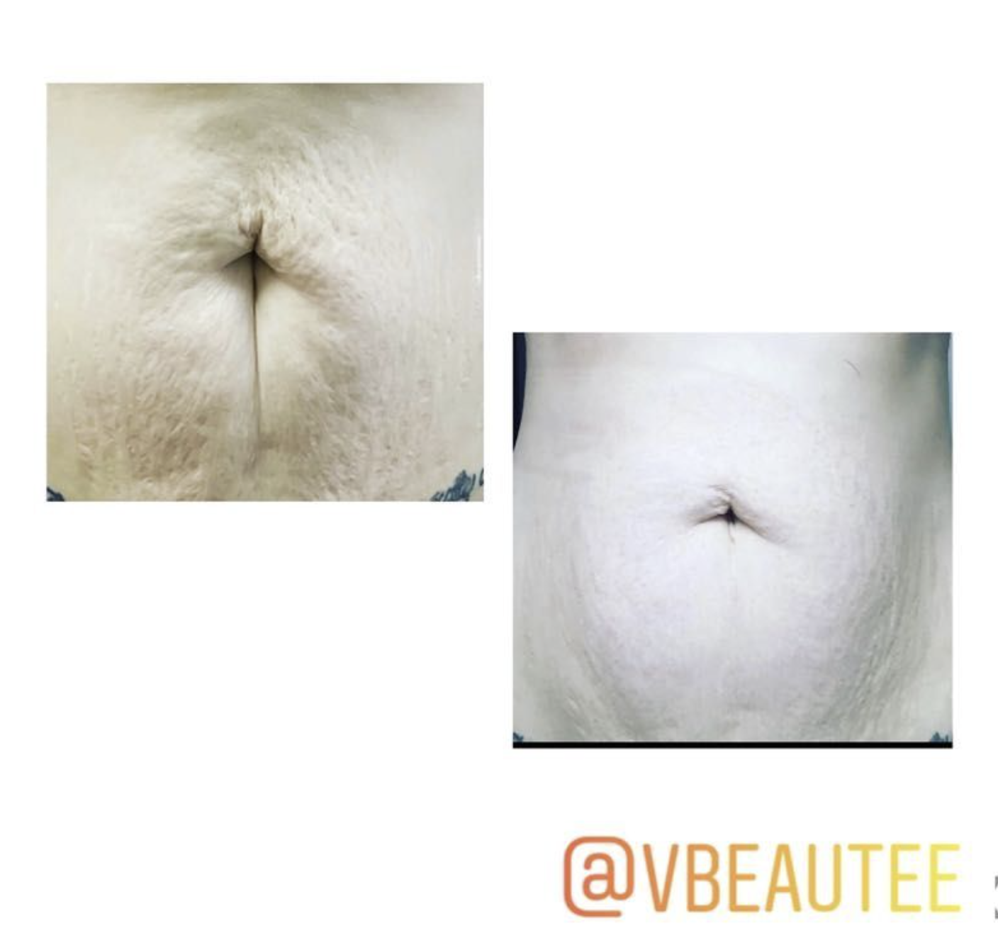 Body skin tightening results