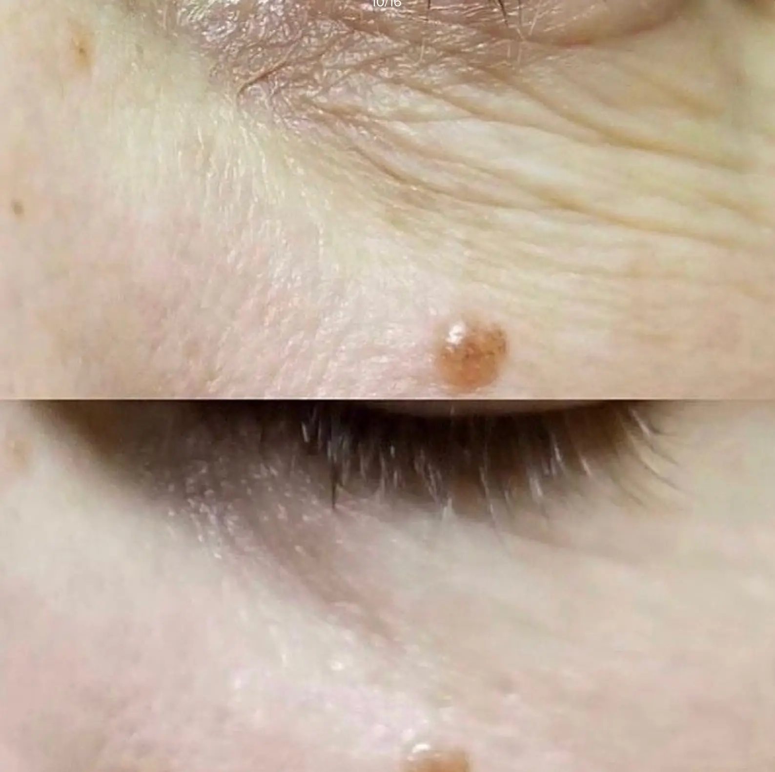 Skin tag removal results