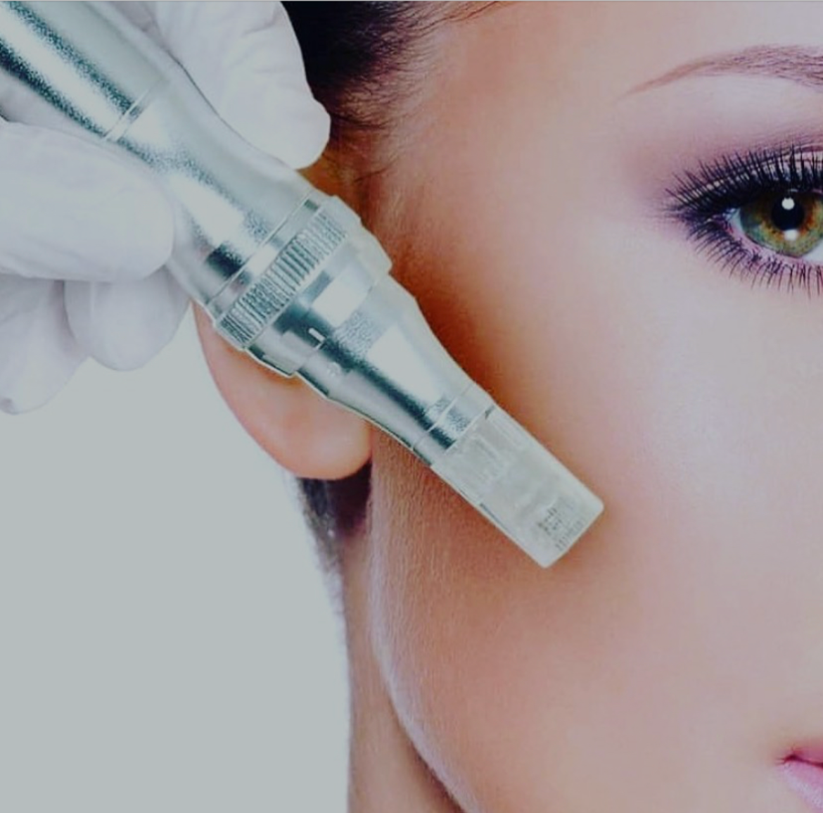 Microneedling treatment performed at V Beautee Aesthetics