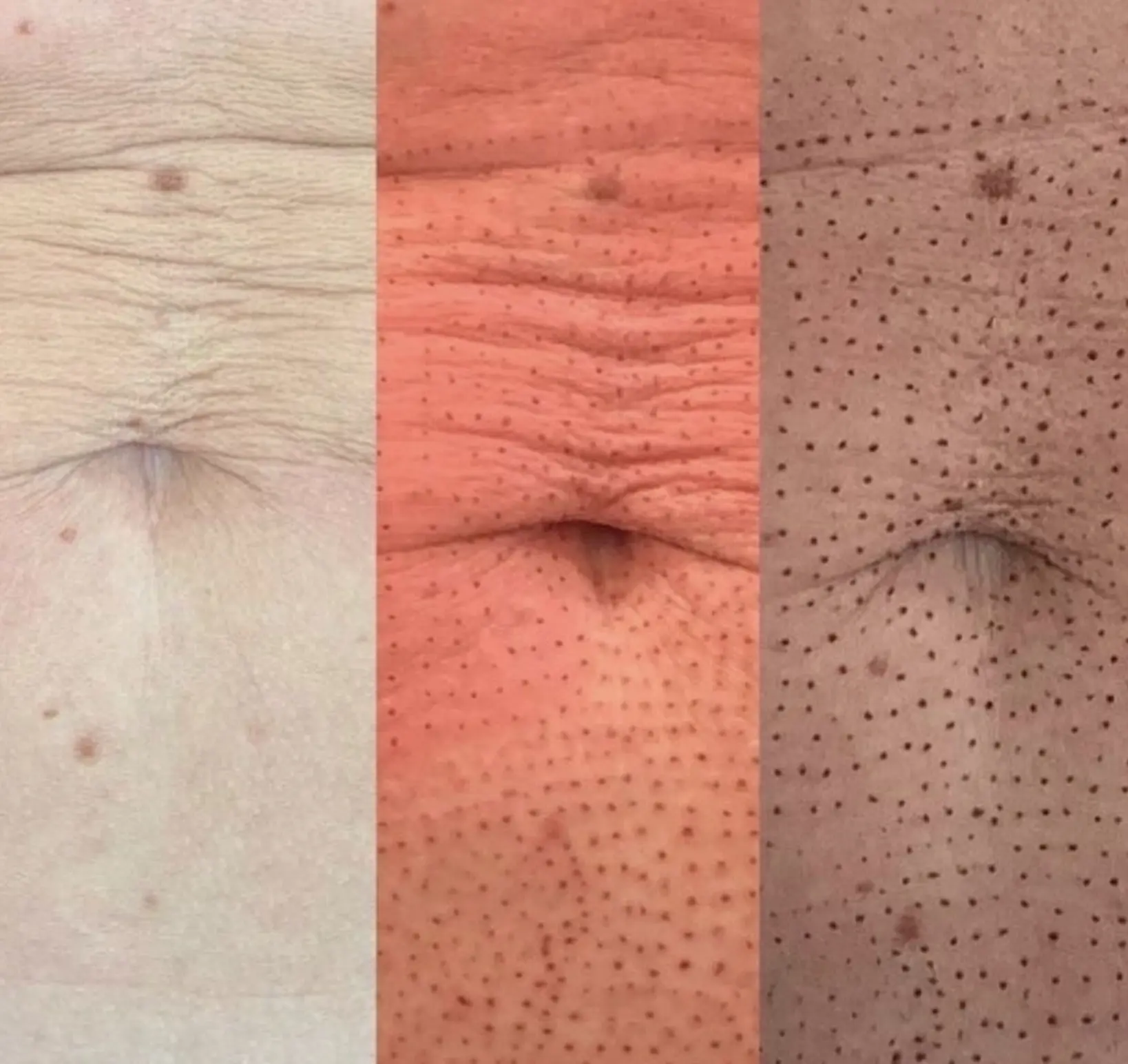 Skin tightening treatment progress
