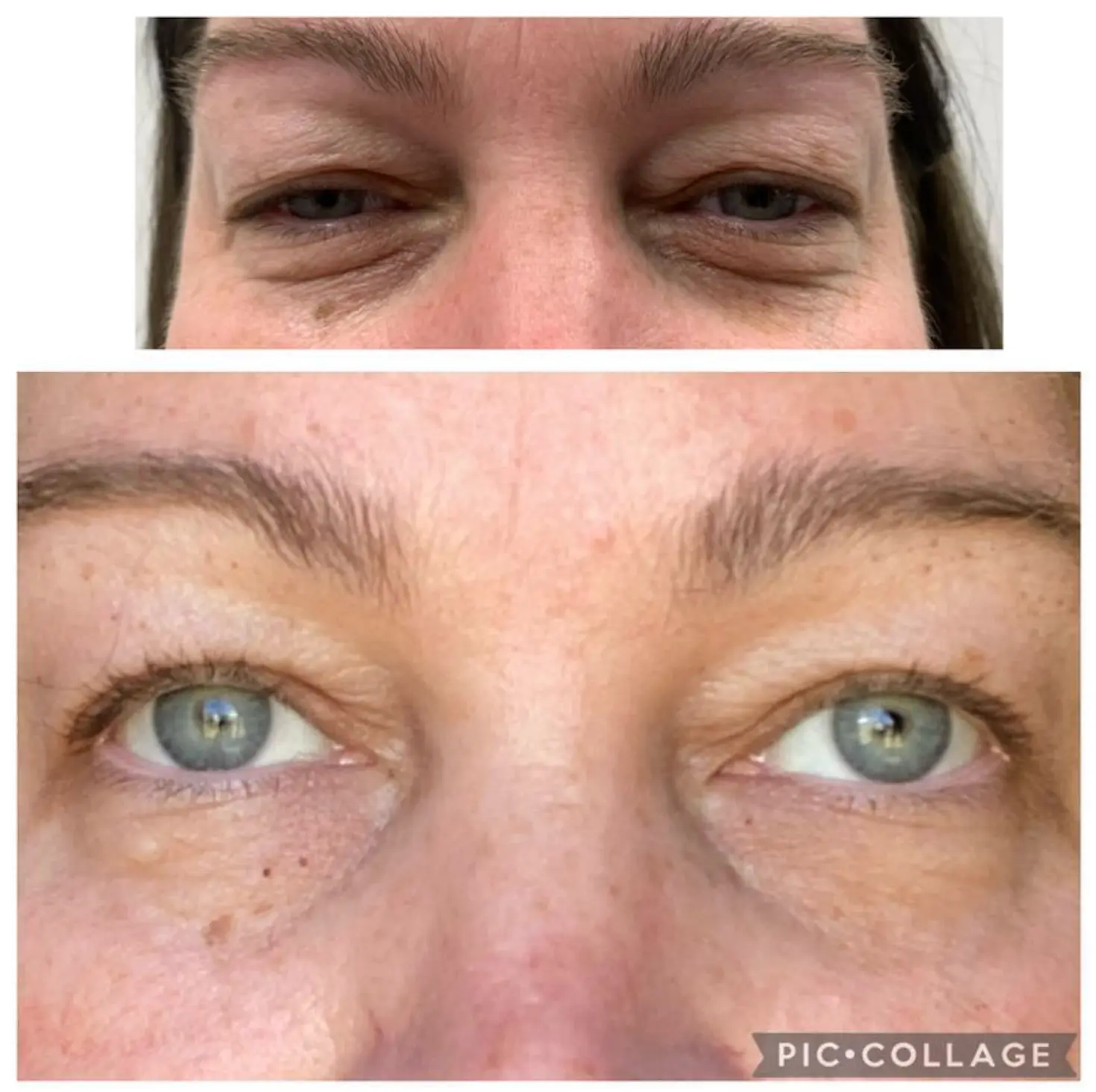 Under-eye treatment results