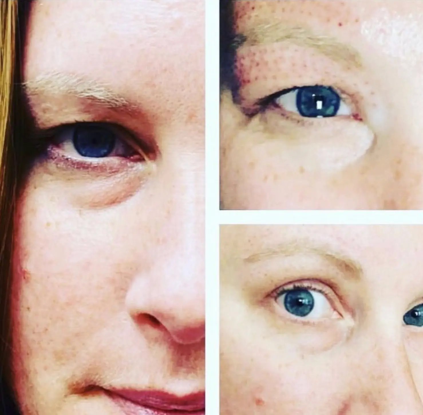 Eye-area treatment results
