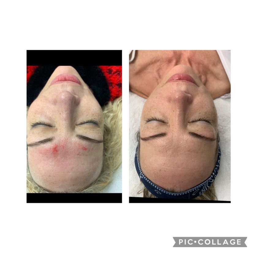 Facial treatment — calmer, clearer skin